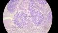 经典病例学习-视网膜母细胞瘤图17