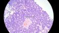 经典病例学习-视网膜母细胞瘤图22