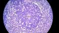 经典病例学习-视网膜母细胞瘤图24