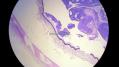 经典病例学习-视网膜母细胞瘤图7