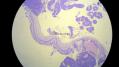 经典病例学习-视网膜母细胞瘤图11
