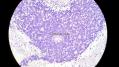 经典病例学习-视网膜母细胞瘤图29