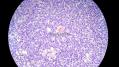 经典病例学习-视网膜母细胞瘤图26