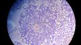 经典病例学习-视网膜母细胞瘤图25