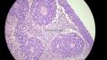 经典病例学习-视网膜母细胞瘤图19