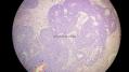 经典病例学习-视网膜母细胞瘤图13