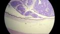 经典病例学习-视网膜母细胞瘤图5