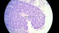 经典病例学习-视网膜母细胞瘤图30