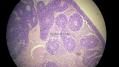 经典病例学习-视网膜母细胞瘤图16