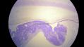 经典病例学习-视网膜母细胞瘤图8