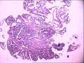 结肠病变（最后诊断：高分化腺癌。）图1