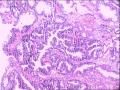 结肠病变（最后诊断：高分化腺癌。）图2