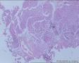 膀胱肿瘤（电切）图9