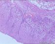 膀胱肿瘤（电切）图19