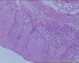 膀胱肿瘤（电切）图18