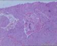膀胱肿瘤（电切）图16