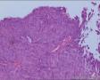 膀胱肿瘤（电切）图20