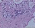膀胱肿瘤（电切）图13
