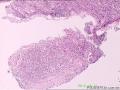 请各位老师指导，胃镜炎症里面的大细胞是什么细胞？为什么会有病理性核分裂像？？图2