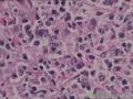 请各位老师指导，胃镜炎症里面的大细胞是什么细胞？为什么会有病理性核分裂像？？图8