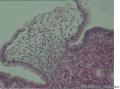 60岁，十二指肠球穿孔，大家看看这些是组织细胞吧？像印戒细胞不？图10