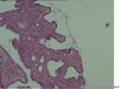 60岁，十二指肠球穿孔，大家看看这些是组织细胞吧？像印戒细胞不？图2