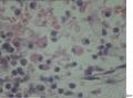 60岁，十二指肠球穿孔，大家看看这些是组织细胞吧？像印戒细胞不？图6