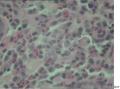 60岁，十二指肠球穿孔，大家看看这些是组织细胞吧？像印戒细胞不？图7