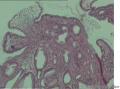 60岁，十二指肠球穿孔，大家看看这些是组织细胞吧？像印戒细胞不？图1