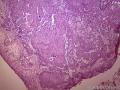 老师帮忙看看：膀胱的浸润性尿路上皮癌伴鳞状分化吗？图1