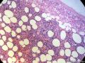 经典病例学习-肾上腺髓脂肪瘤图6