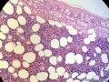 经典病例学习-肾上腺髓脂肪瘤图5