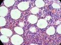 经典病例学习-肾上腺髓脂肪瘤图9
