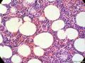 经典病例学习-肾上腺髓脂肪瘤图8