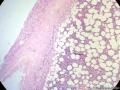 经典病例学习-肾上腺髓脂肪瘤图2