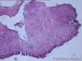 膀胱肿物图1