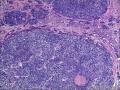 食管腺样囊性癌OR 食管基底样鳞状细胞癌OR神经内分泌肿瘤图10