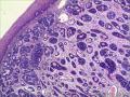 食管腺样囊性癌OR 食管基底样鳞状细胞癌OR神经内分泌肿瘤图4