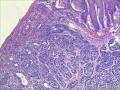 食管腺样囊性癌OR 食管基底样鳞状细胞癌OR神经内分泌肿瘤图6