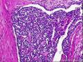 胃窦部胃壁肿物冰冻切片（已添加HE切片及免疫组化）图21
