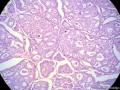 经典病例学习-乳腺浸润性筛状癌图2