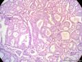 经典病例学习-乳腺浸润性筛状癌图4