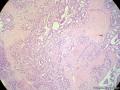 经典病例学习-乳腺浸润性筛状癌图13