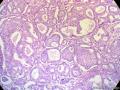 经典病例学习-乳腺浸润性筛状癌图1