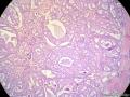 经典病例学习-乳腺浸润性筛状癌图9