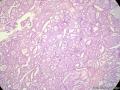 经典病例学习-乳腺浸润性筛状癌图11
