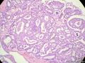 经典病例学习-乳腺浸润性筛状癌图5