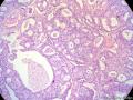 经典病例学习-乳腺浸润性筛状癌图6