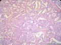 经典病例学习-乳腺浸润性筛状癌图10