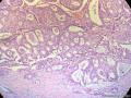 经典病例学习-乳腺浸润性筛状癌图3